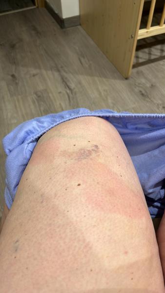 Fľaky - modriny po pôrode