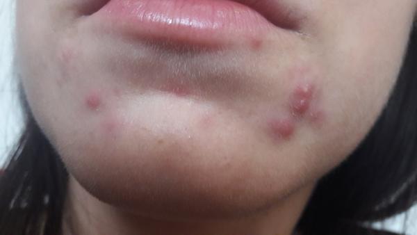 Z čoho mám už druhý mesiac vyrážky?