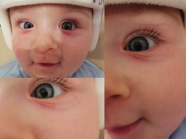 Ako keby vyrážky pri očkách