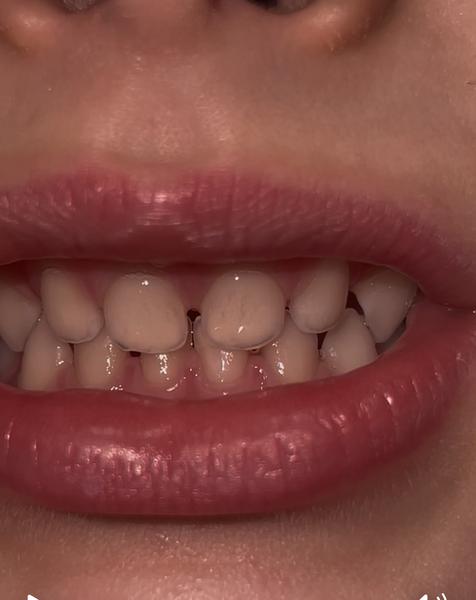 Pásiky na detských zuboch, čo môže byť príčinou?