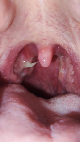 Je nutná návšteva lekára pri boľavom hrdle?