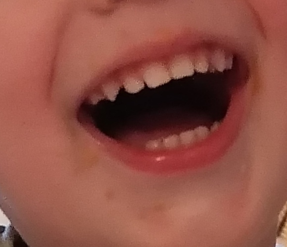 Ako liečiť zvlnené okraje zúbkov u dvojročného syna?