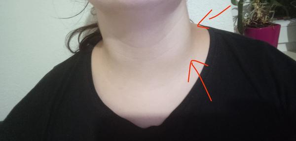 Opuch a možná uzlina