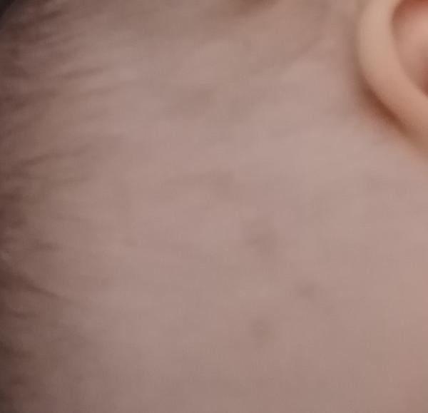 Fľaky na hlave u ročného syna