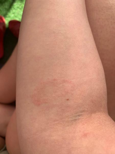 Po tele sa mi robia červené fľaky