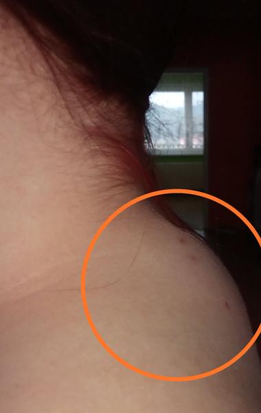 Mám bolesť krčnej chrbtice z hrbu?