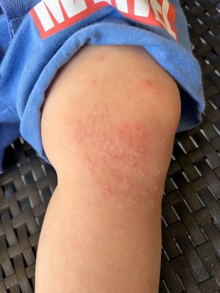 O aký kožný problém ide?