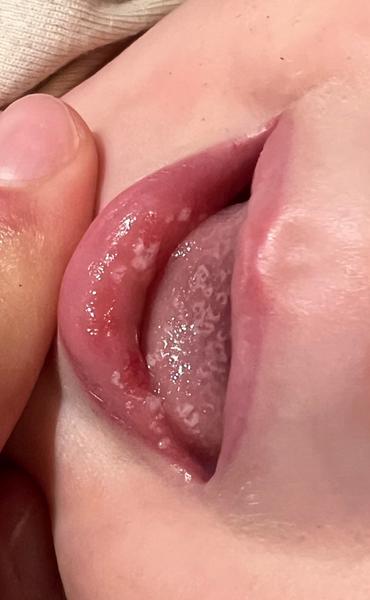 Čo to má môj 9-mesačný syn na perách a jazyku?