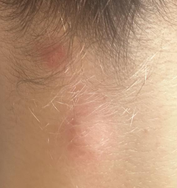 Čo môže spôsobiť hrbole na hlave?