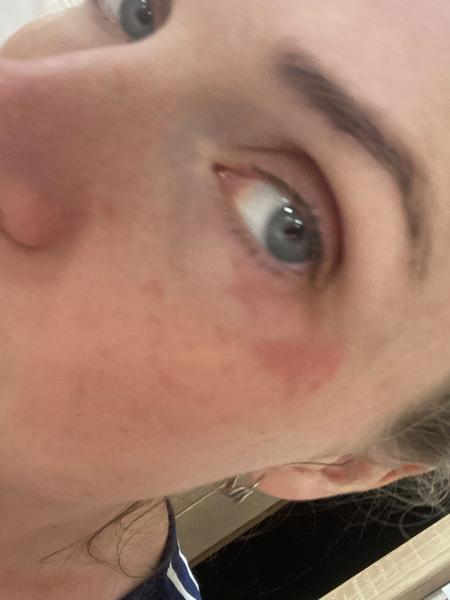 Pomôže čínska medicína na vyrážky pod očami?