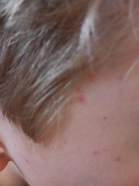 Aká je toto vyrážka?