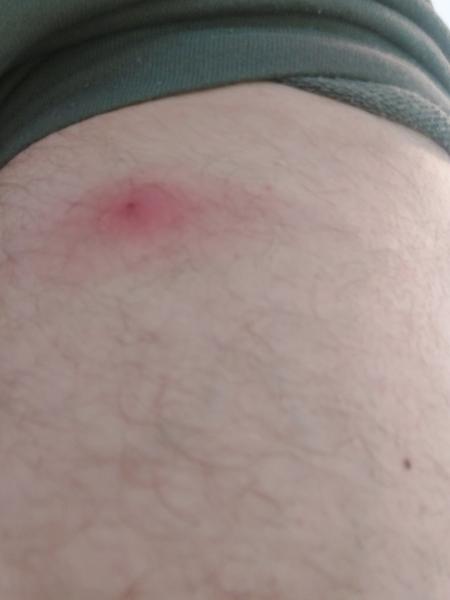 Mám navštíviť lekára s abscesom na nohe?