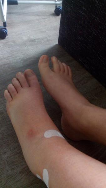 Operácia kŕčových žíl laserom