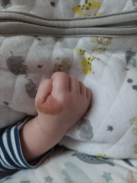 Hnedý fľak u bábätka