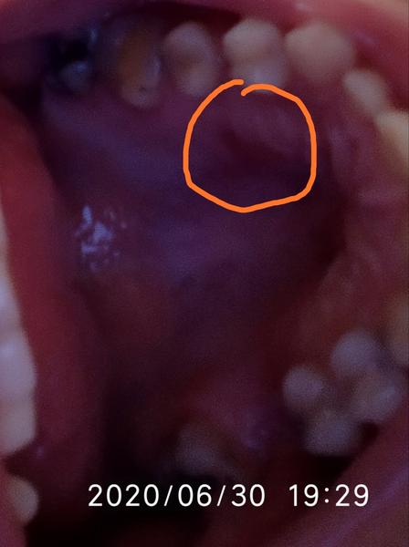 Aká je príčina červenej škrvny na podnebí?