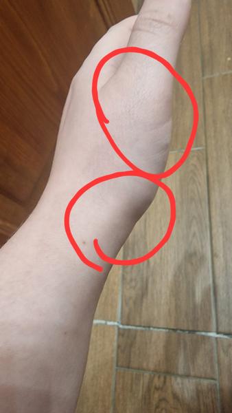 Pulzujúca bolesť zápästia a palca