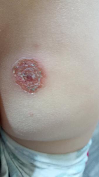 Čo to môže byť za vyrážky?