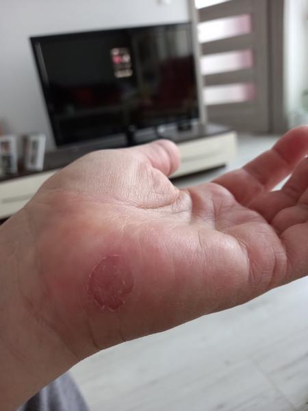 Čo to mám na ruke?