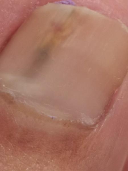 Čierne fľaky na nechte