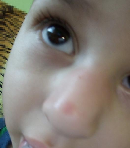 Je podľa vás toto zlomený nos?