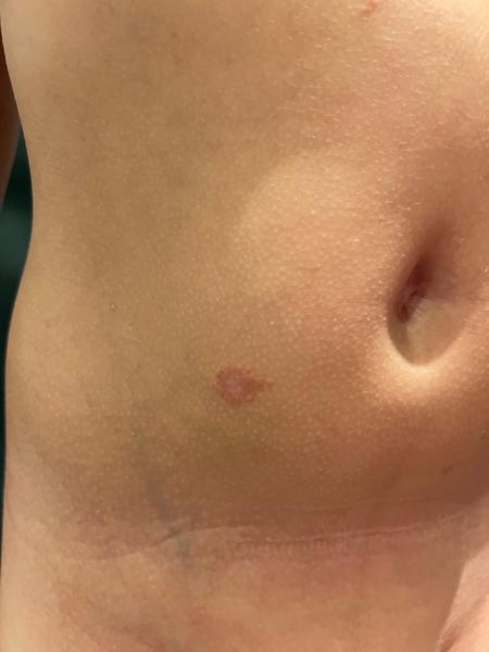 Má 7-ročný syn ekzém na bruchu?