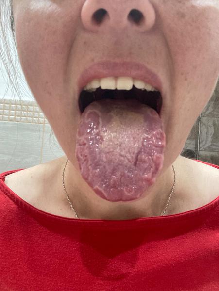 Biely povlak na jazyku v 33. týždni