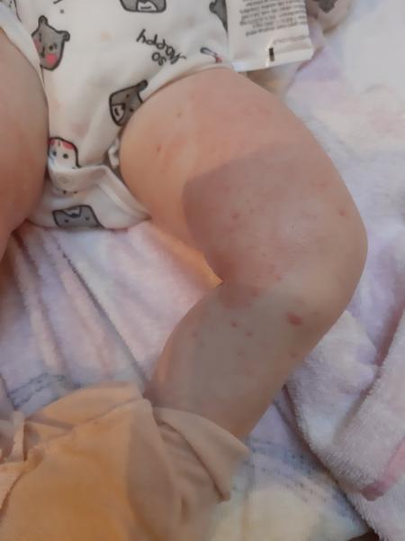 Ako sa zbaviť fľakov a vyrážok na stehnách 20-mesačnej?