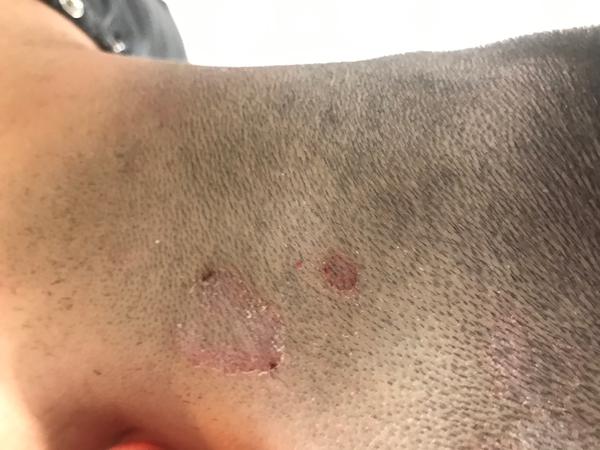 Má môj 11 ročný syn seboreu?