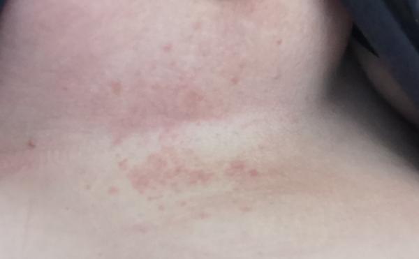 Čo sú to za vyrážky?