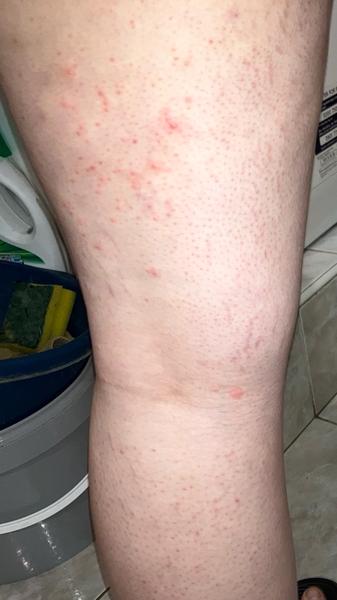 Aké sú toto vyrážky?