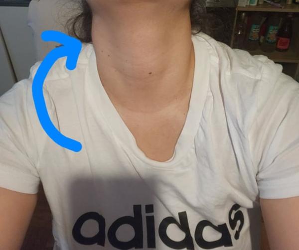 Tvrdá hrčka na krku