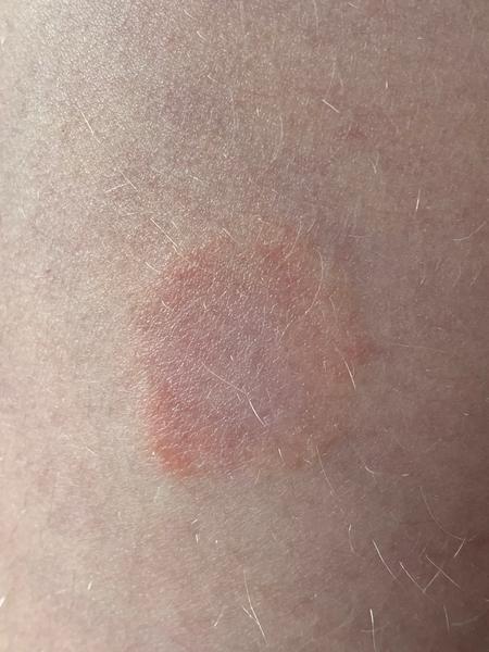 Aké fľaky sa robia mojej dcérke na koži?