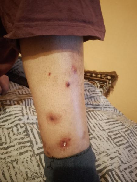 Skúsenosti s vyrážkami po imunoterapii