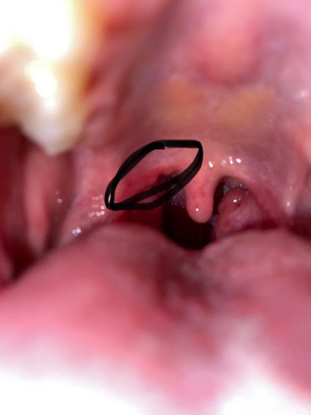 Čo znamenajú takéto výrastky na sliznici?