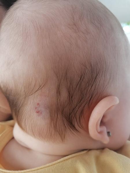 Dcérka má od narodenia na hlavičke ako keby modrinu a krvné zrazeninky