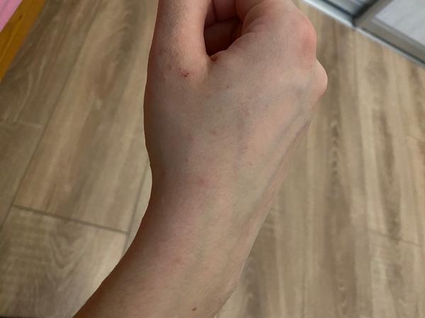 Čo spôsobuje takéto vyrážky na rukách?