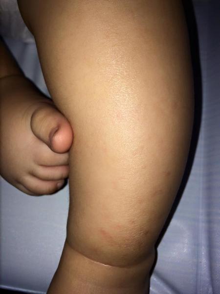 Čo je toto na nožičke môjho 6 mesačného drobca?