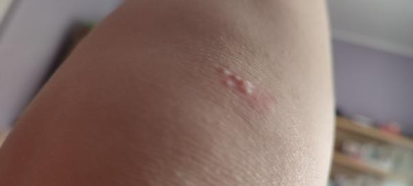 Čo mám robiť s bolesťou kolena?