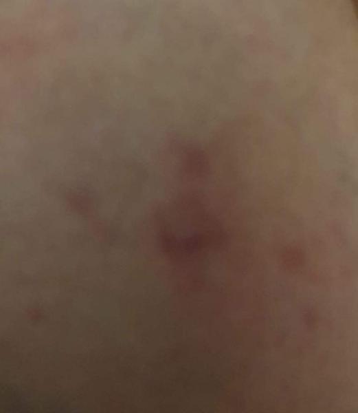 Uštipnutie na stehno