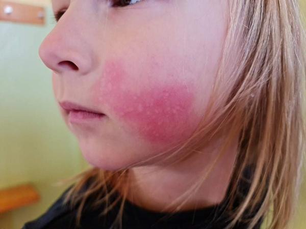 Aký fľak mala moja dcérka na líčku?