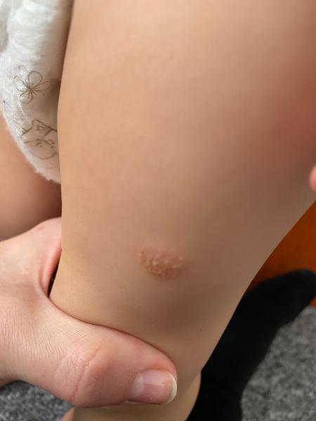 Kožný problém u 1,5-ročného syna