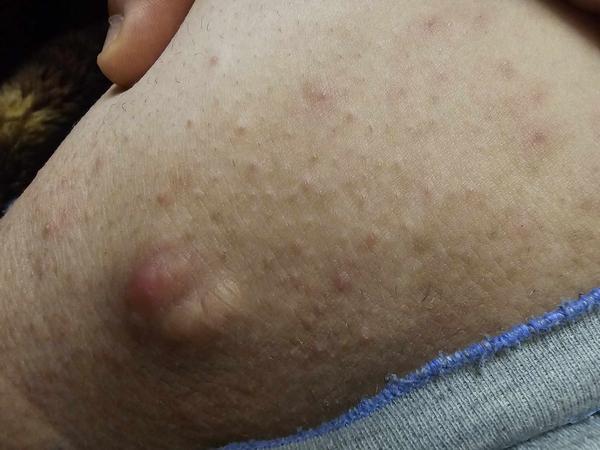 Čo môže spôsobiť vyrážku na stehne?