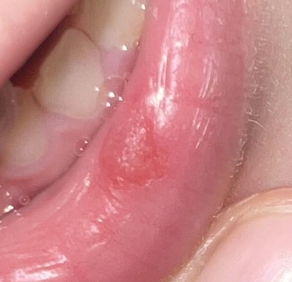 Je to herpes alebo nie?