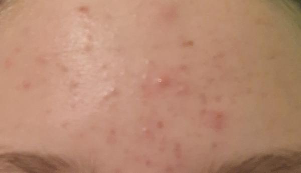 Čo pomáha na akné pri citlivej pleti?