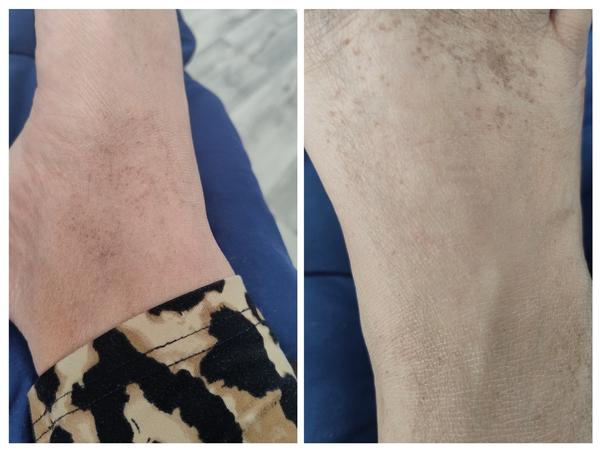 Bodky na nohách u detí