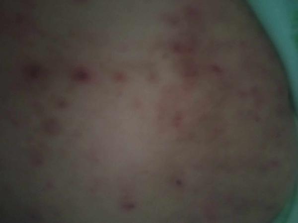 Ako liečiť vyrážky u ležiacej babky?