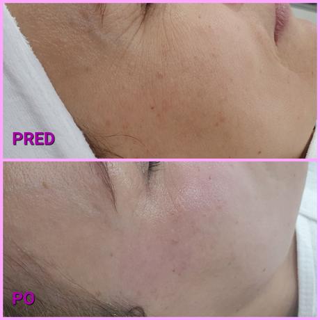 Radiothermolifting - omladenie rádiofrekvenciou, 