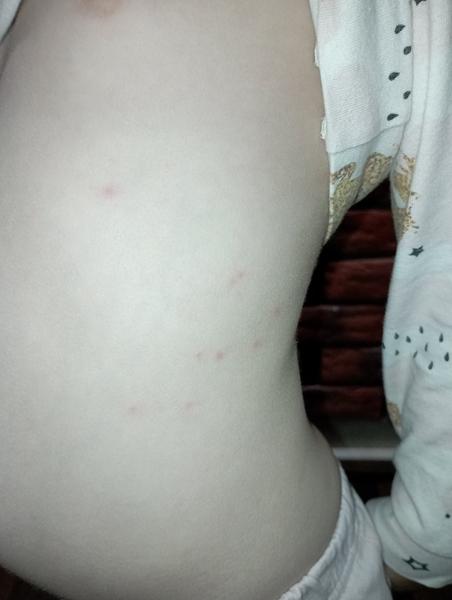 Z čoho sa vytvorili dcérke takéto svrbivé vyrážky?