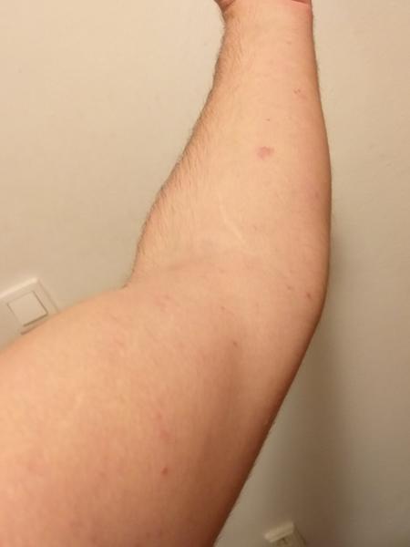 Z čoho môžem mať takéto vyrážky?