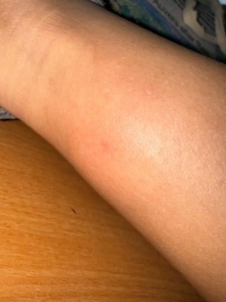 Kliešťová katastrofa: Je opuch dôvod na obavy?